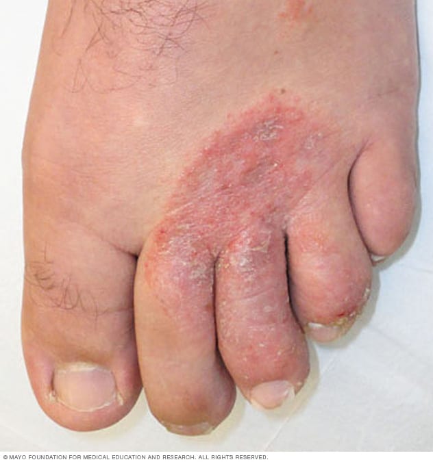 Gljivica na stopalu i nogama, i kako ih spriječiti